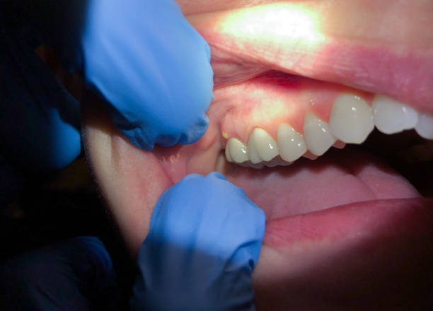Best Emergency Dental Care for Sports Injuries in Broadlands, VA